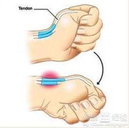 腱鞘炎封闭视频,腱鞘炎封闭治疗操作步骤详解