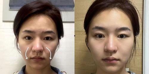 法令纹怎么消除视频,视频揭秘高效护肤秘诀